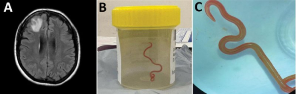 Australian study warns over parasitic infections after roundworm found in woman's brain