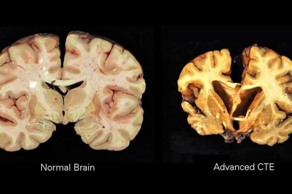 Brain study reveals 41% of young athletes under 30 had signs of CTE