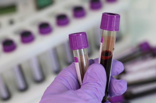 Blood test measuring DNA damage may help diagnose Parkinson's disease