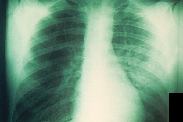 Human radiologists beat AI in diagnosing common lung diseases on X-rays