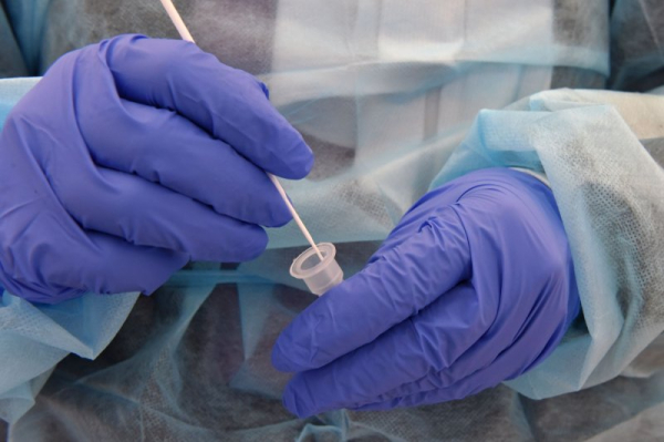 COVID-19 linked to higher risk for autoimmune diseases like alopecia, Crohn's