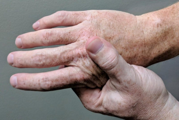 Guillain-Barr&eacute; syndrome risk greater after COVID-19, study indicates