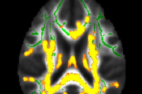 Hidden belly fat in midlife linked to Alzheimer's disease, research indicates Hidden belly fat in midlife linked to Alzheimer's disease, research indicates