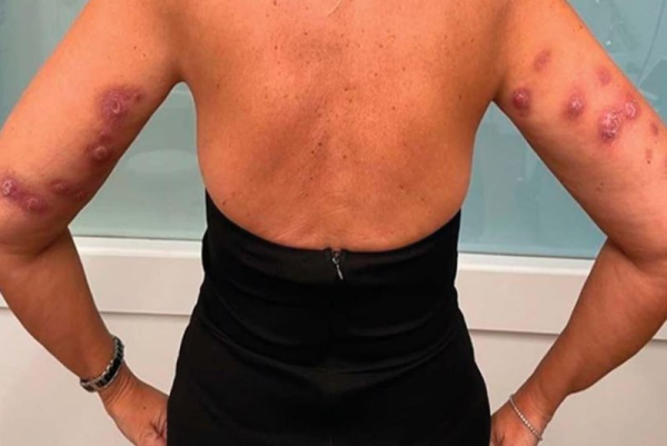 FDA warns of scarring, deformities from unapproved 'fat-dissolving' injections FDA warns of scarring, deformities from unapproved 'fat-dissolving' injections