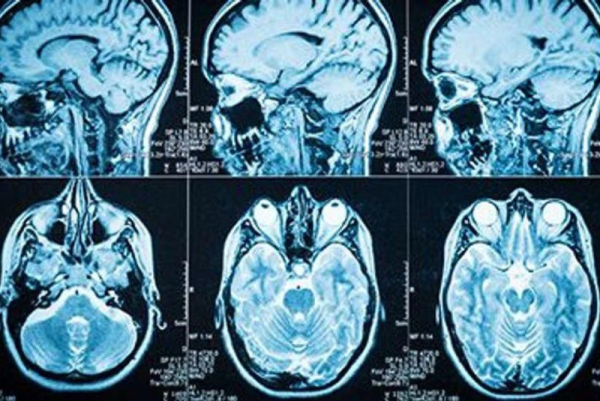 Growth hormone given to kids may be linked to Alzheimer's, study shows Growth hormone given to kids may be linked to Alzheimer's, study shows