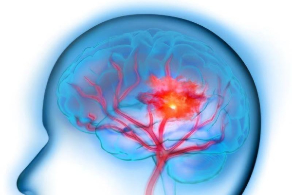 Combo of blood thinners, clot-busting meds doesn't benefit stroke patients Combo of blood thinners, clot-busting meds doesn't benefit stroke patients