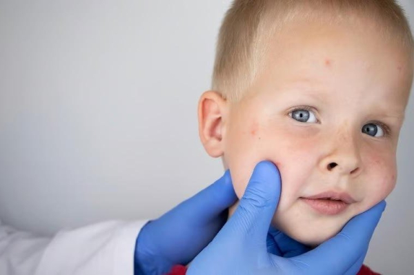 Florida surgeon general defers to parents over CDC during measles outbreak
