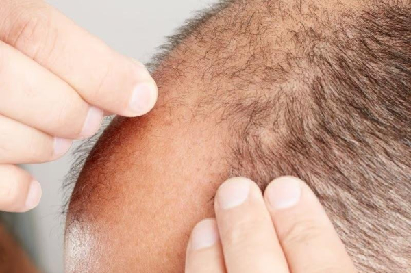 Hair loss drug in Propecia, Proscar may lower risk of heart disease