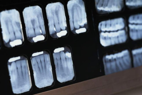 Lead aprons no longer necessary for dental X-rays Lead aprons no longer necessary for dental X-rays