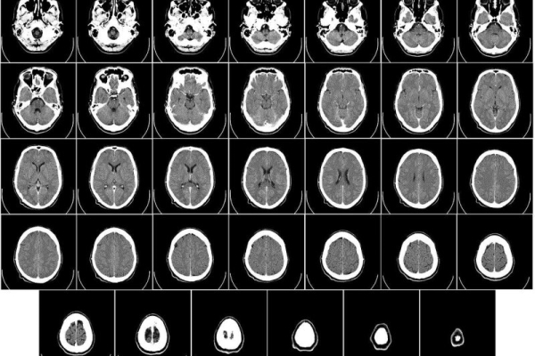 Report: Aggressive brain tumors respond to new, immune-focused therapy