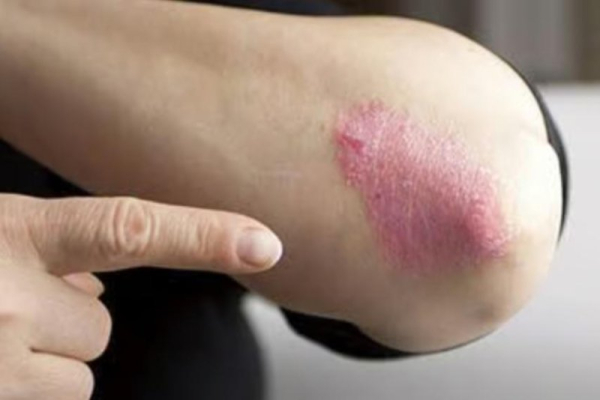 Researchers identify gene mutation that causes psoriasis