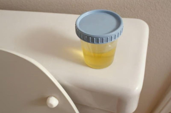 New urine test could allow bladder cancer survivors to avoid cystoscopy