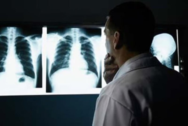 Few Americans get recommended lung cancer screening Few Americans get recommended lung cancer screening