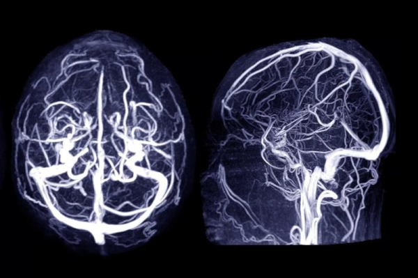 Statins, metformin associated with lower risk of brain aneurysms
