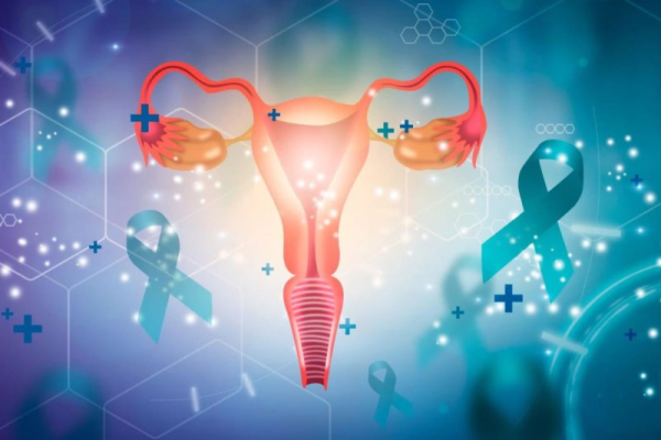 Endometriosis linked to much higher odds of ovarian cancer