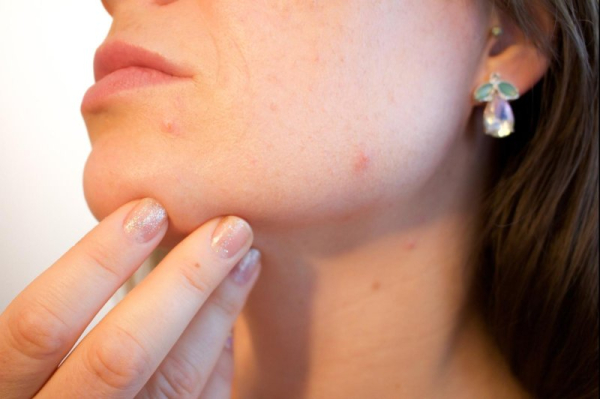 Omega-3 fatty acids, plant-based diet can improve acne, study shows