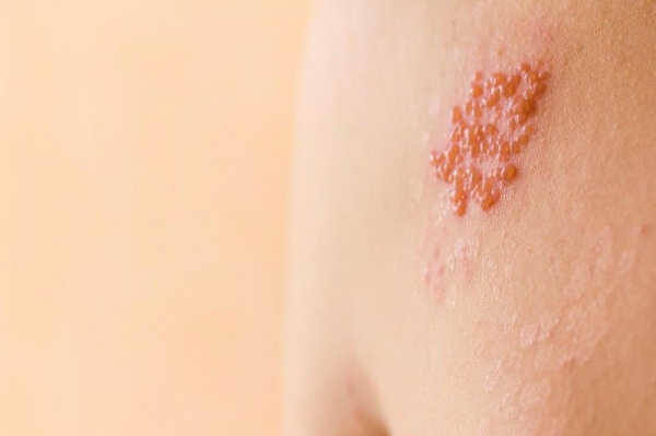 Shingles may increase risk of cognitive decline Shingles may increase risk of cognitive decline