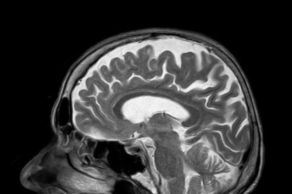 FDA approves new schizophrenia drug