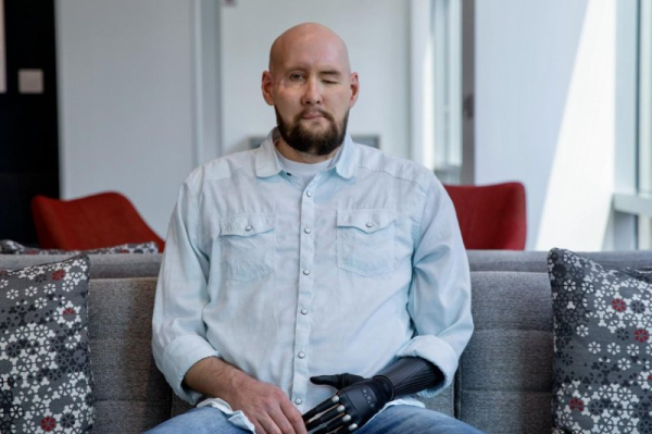 World's first combined whole eye, face transplant at NYU called success World's first combined whole eye, face transplant at NYU called success