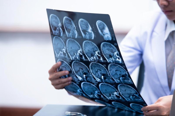 Alzheimer's disease might damage brain in two phases Alzheimer's disease might damage brain in two phases