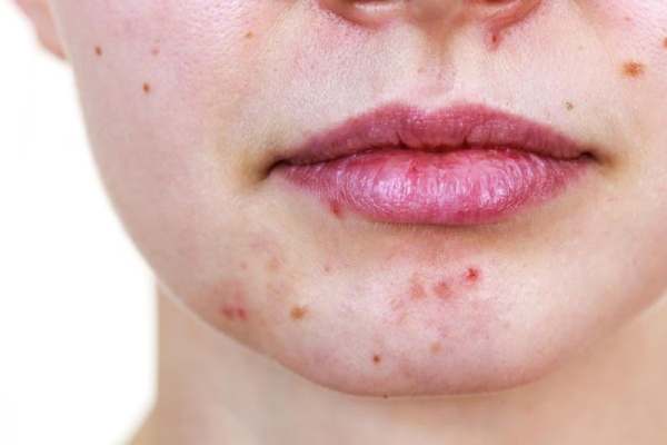 Common acne creams might become carcinogenic at room temperature Common acne creams might become carcinogenic at room temperature