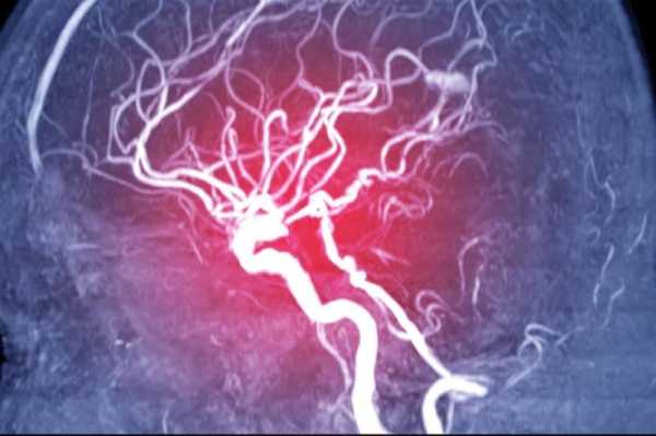 DBS treatment might help restore mobility in brain injury patients