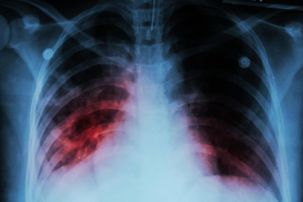 Tuberculosis once again top killer among world's infectious diseases Tuberculosis once again top killer among world's infectious diseases