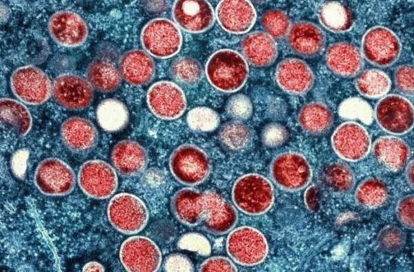 Additional case of new mpox strain detected in Britain for a total of four