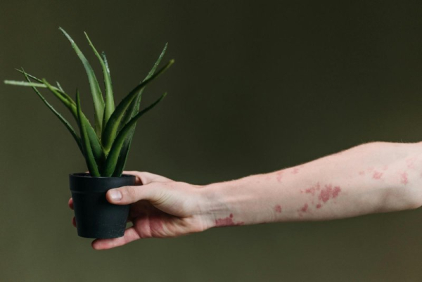 Eczema risk seems to increase from polluted air, study finds Eczema risk seems to increase from polluted air, study finds