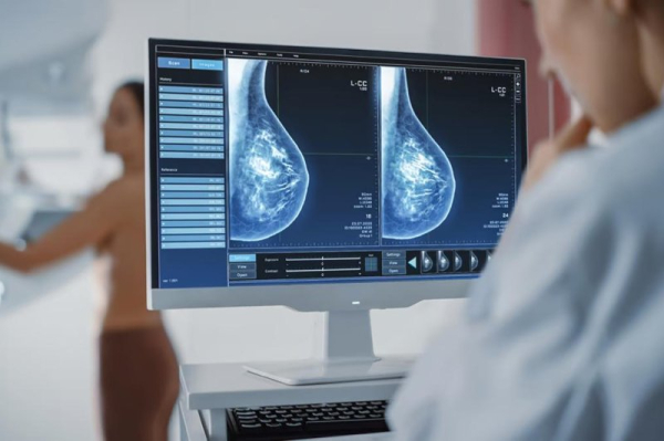 AI compares mammograms over time to help predict breast cancer