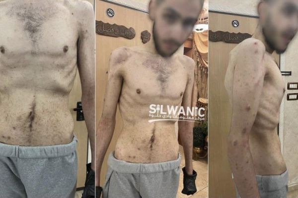 Palestinian captives released in cease-fire show signs of torture