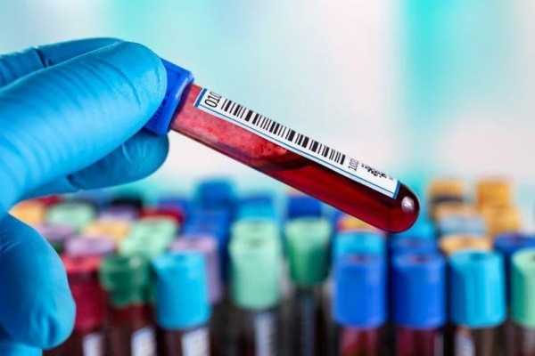 Blood test may predict rapid brain decline in Alzheimer's patients