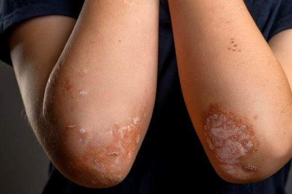 Psoriasis in kids linked to parents' divorce, separation Psoriasis in kids linked to parents' divorce, separation