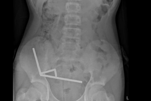 Teen boy swallows 80+ magnets, surgeons remove part of bowel Teen boy swallows 80+ magnets, surgeons remove part of bowel