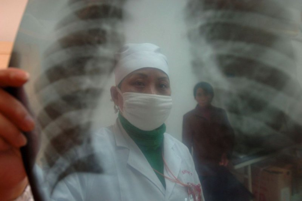 Lung cancer remains deadliest cancer, but patients are living longer