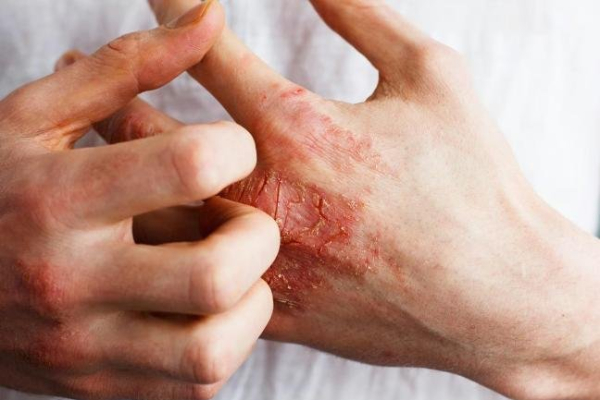 Eczema injectable drug provides quick itch relief, trial results show